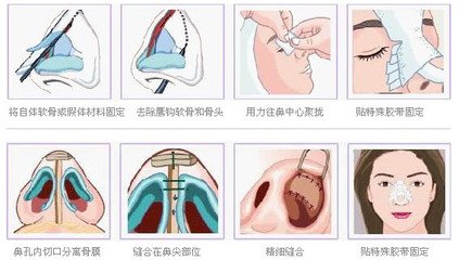 韩式隆鼻技术的最新进展，塑造完美鼻型的时尚新选择！