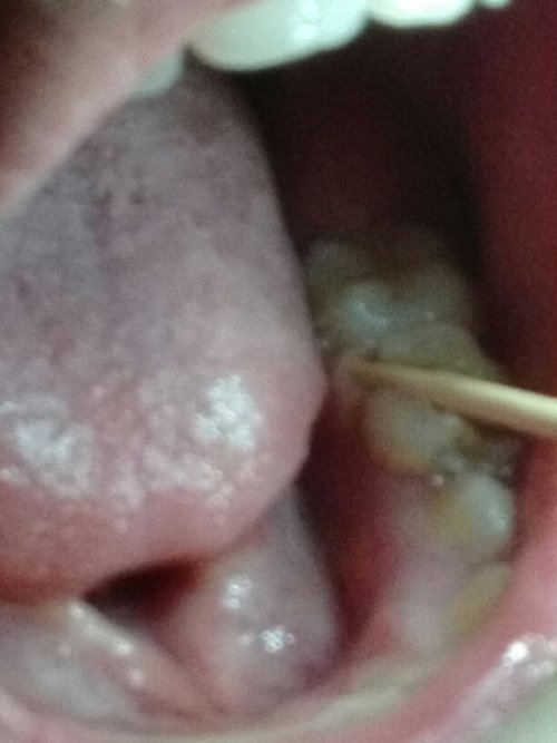 最新换虫牙科普解析，换牙知识详解